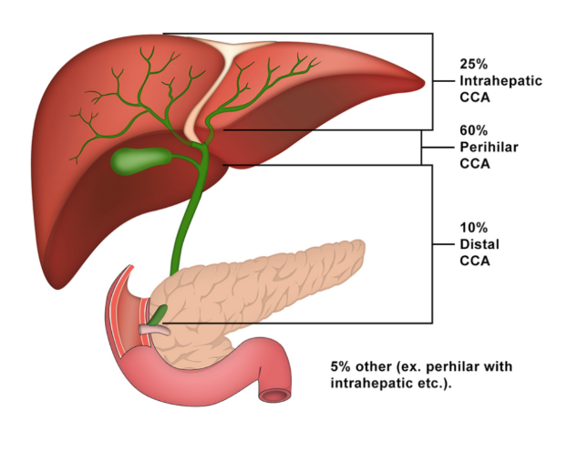 มะเร็งท่อน้ำดี